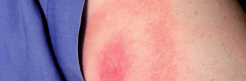 Typical bulls-eye rash from Lyme disease