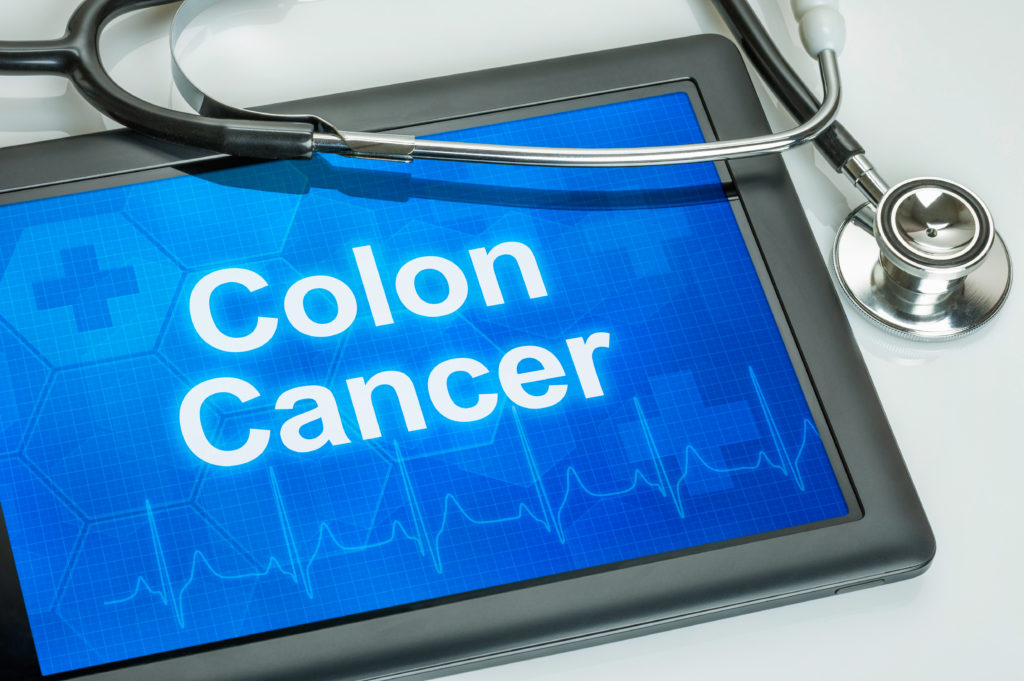 Colon cancer